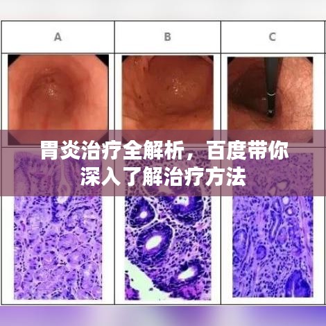 胃炎治疗全解析,百度带你深入了解治疗方法