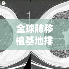 全球肺移植基地排名与肺移植最新进展报告